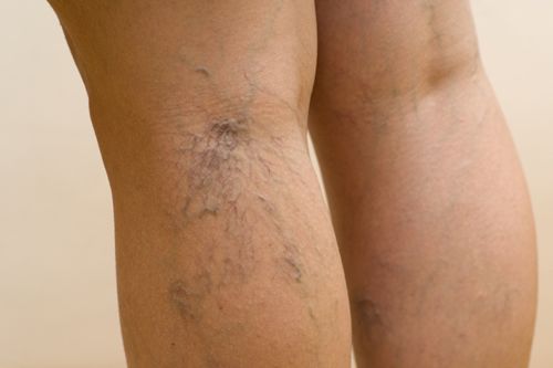 Cara Mengatasi Trombosis Vena Dalam
