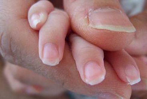 Kuku terkelupas, garis-garis vertikal muncul di permukaan