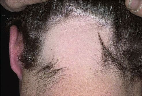 Alopesia areata