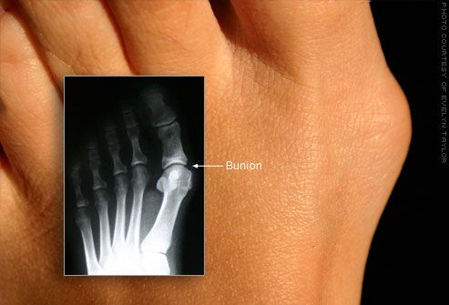 Deformitas bunion vulgus pada jempol kaki