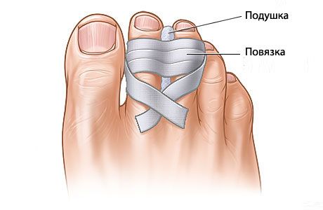 Apa prospek memulihkan patah jari kaki?