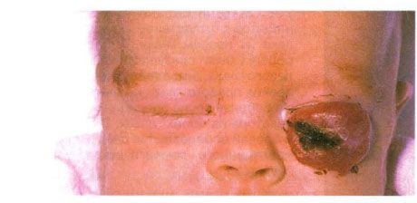 Hemangioma kelopak mata bawah.
