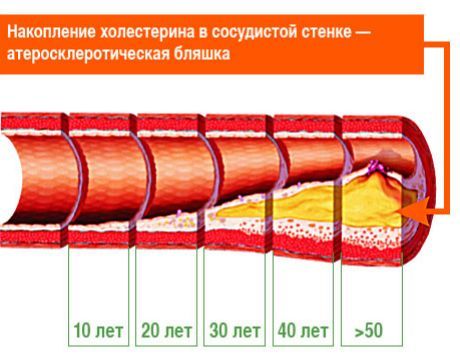 Terungkap plak aterosklerosis mana yang bertanggung jawab atas stroke