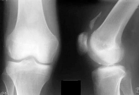Roentgen dari sendi lutut