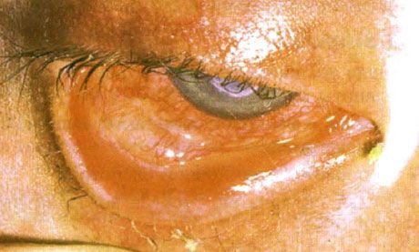 Sindrom Stevens-Johnson.  Konjungtivitis deskuamatif dua sisi dengan daerah nekrosis.  Keratitis berat, yang menyebabkan munculnya bekas luka di kornea.  Situasinya diperumit dengan penambahan sindrom mata "kering"