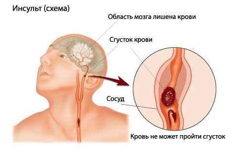 Tes mudah memprediksi stroke fatal