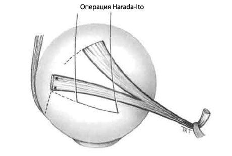 Strabismus - Operasi