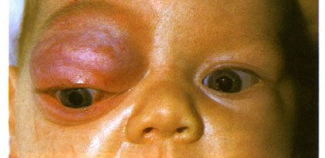 Hemangioma kapiler pada rongga mata anterior dan kelopak mata atas. Neoplasma ini memiliki kecenderungan untuk berkembang