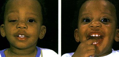 Ptosis unilateral parah dengan tidak adanya lipatan kelopak mata atas pada mata kanan.