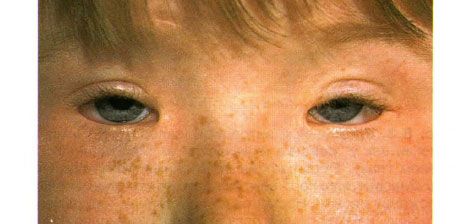 Sindrom Blefarofimosis. Ptosis, Telekantus, dan Blefarofimosis yang Dioperasi Bilateral