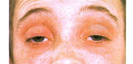 Oftalmoplegia eksternal. Ptosis bilateral. Pasien membuka mata dengan mengangkat alis.