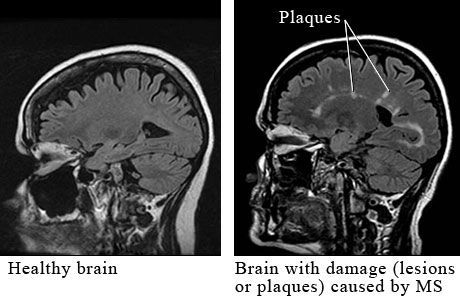 Multiple sclerosis dapat disembuhkan