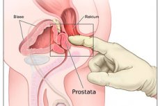 Prostata Stimulering