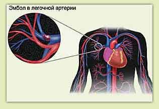 Pulmonary embolism dan nyeri dada di sebelah kiri