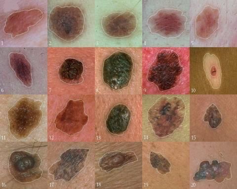 Para ilmuwan telah menemukan gen yang memainkan peran sentral dalam perkembangan melanoma