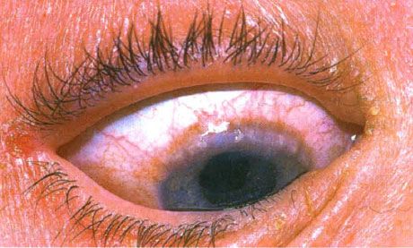 Konjungtivitis vernal limbal. Bintik-bintik trantas terlihat