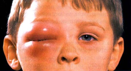 Selulitis ekstraorbital pada anak-anak