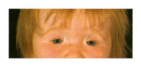 Coloboma dua sisi kelopak mata pada anak dengan sindrom Golden.  Penutupan celah mata di sebelah kiri