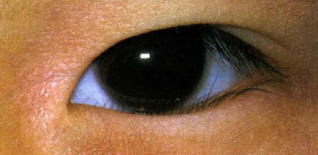 Epiblypharon.  Pertumbuhan bulu mata yang salah dirayakan sejak lahir.  Terkadang terjadi perbaikan spontan